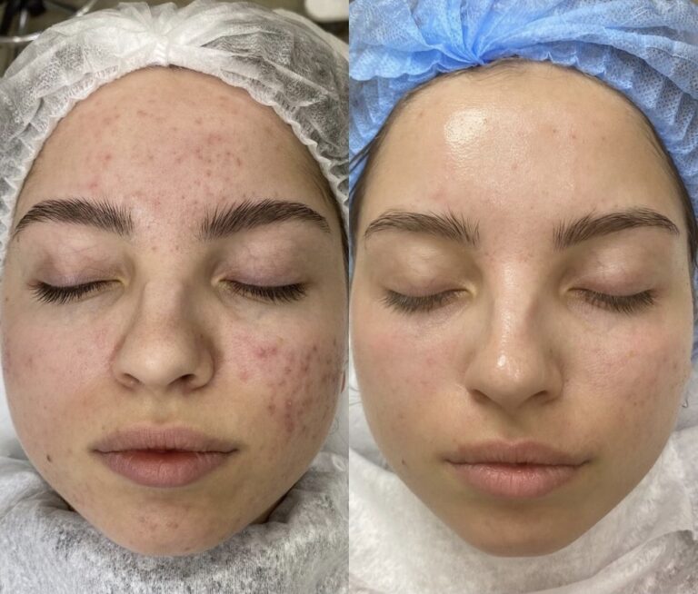 Green-Peel-Before-After-05-768x654